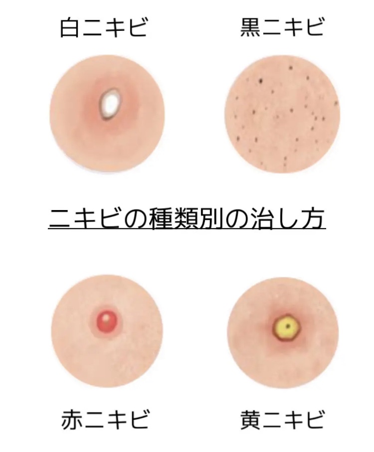 できるニキビによって治し方が違う🍀⁇
ニキビの種類と原因を知ってニキビ対策しよう🌟





どうしてニキビができるのでしょうか。
ニキビの種類によってはできる原因が違うので
それぞれのニキビの対策方法を見て肌を綺麗にしていきましょう�