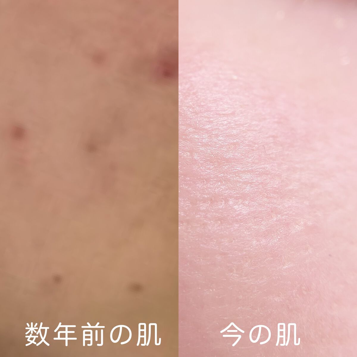 ブライトクリーン/YA-MAN TOKYO JAPAN/美顔器・マッサージを使ったクチコミ（2枚目）