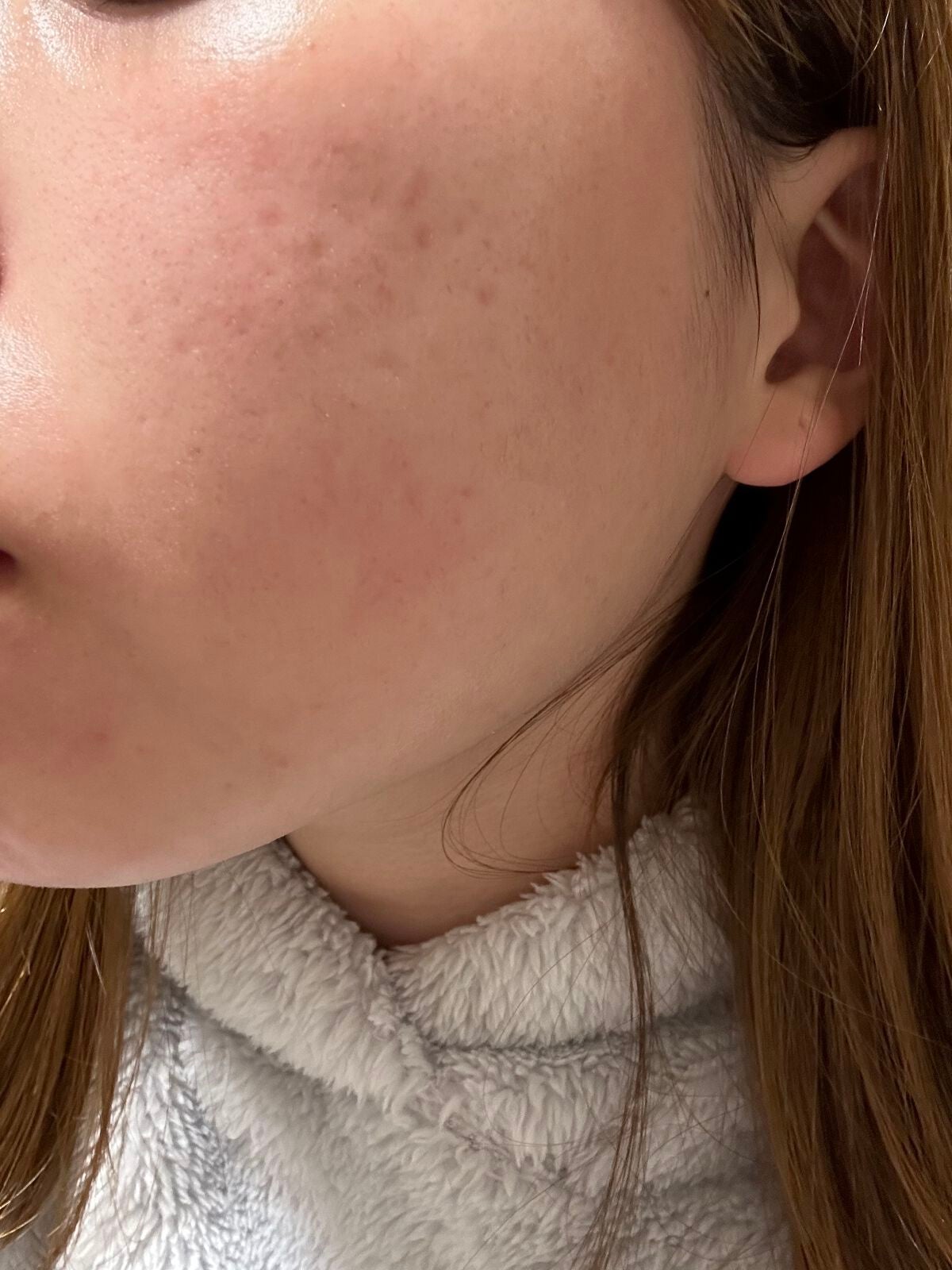 VC100エッセンスローション EX/ドクターシーラボⓇ/化粧水を使ったクチコミ(4枚目)