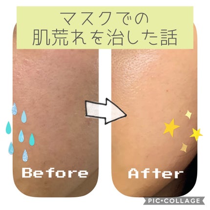 オードムーゲ 薬用ローション(ふきとり化粧水)/オードムーゲ/拭き取り化粧水を使ったクチコミ(1枚目)