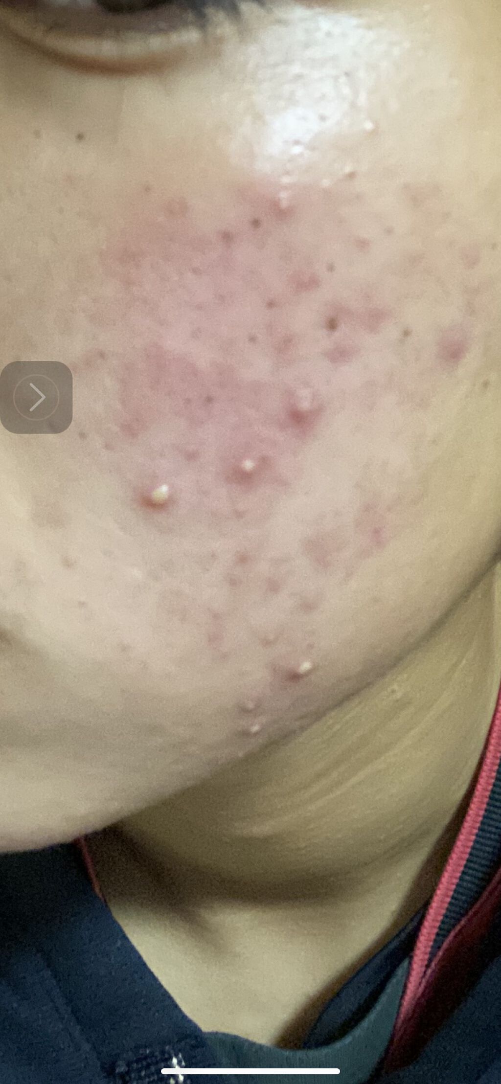 ニキビあとケアジェル/アットノン/その他スキンケアを使ったクチコミ（2枚目）