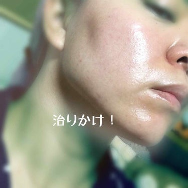 もちづき on LIPS 「凹凸ほぼほぼなくなってきました。薬塗らなくてもスキンケアだけで..」（2枚目）