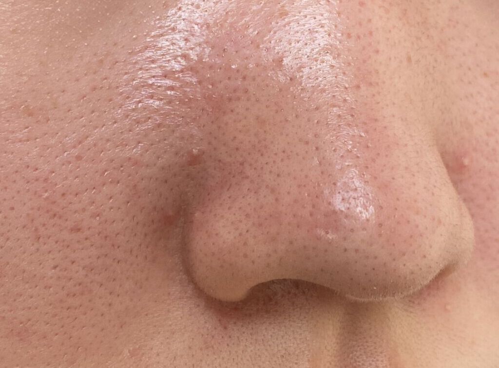 ロゼット洗顔パスタ アクネクリア/ロゼット/洗顔フォームを使ったクチコミ（3枚目）