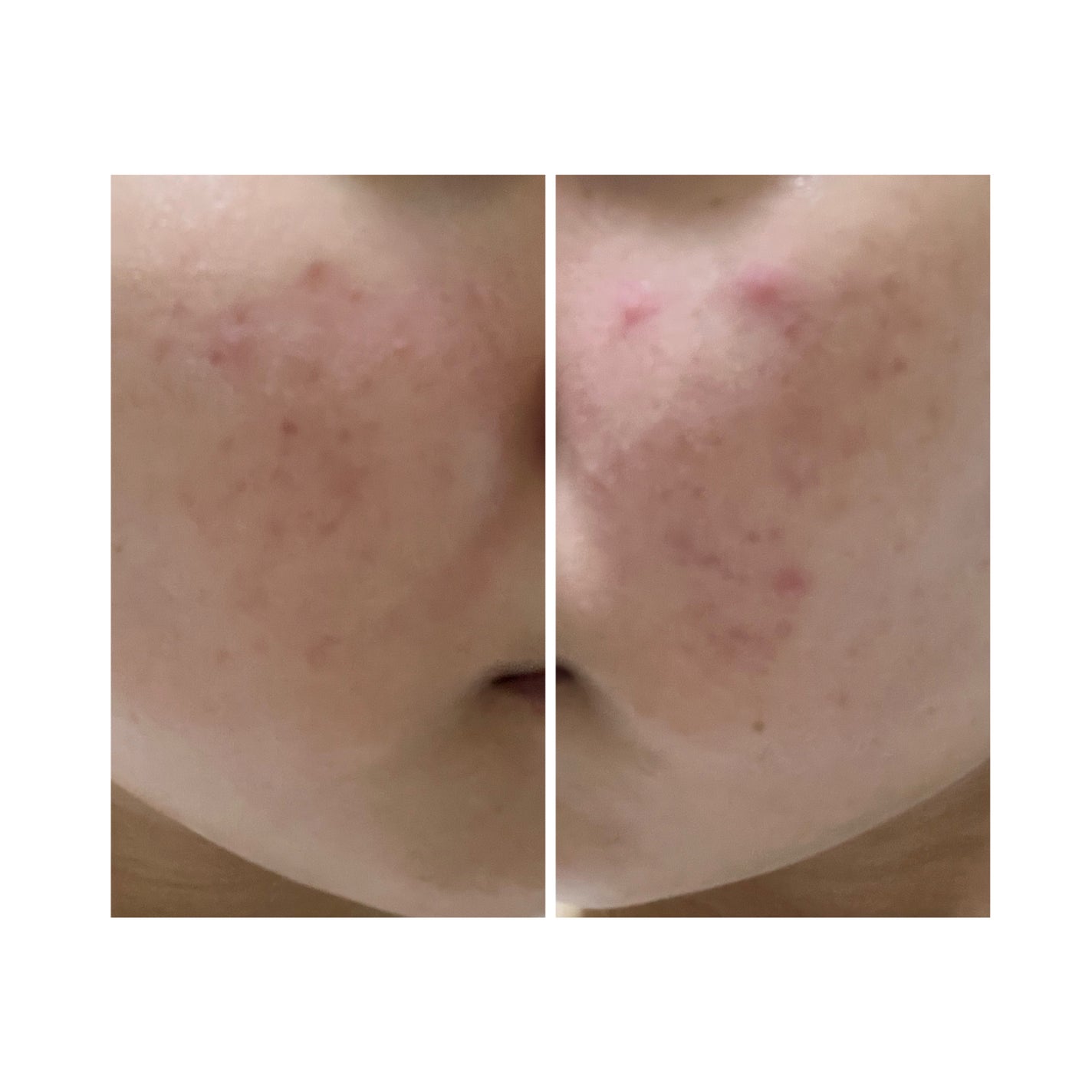 ぽむ on LIPS 「2023.9.13皮膚科に受診 エピデュオとヘパリン処方1枚目..」(3枚目)