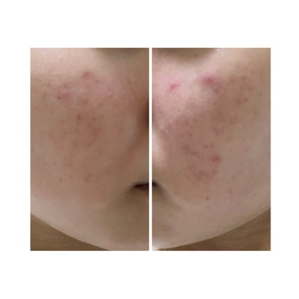 ぽむ on LIPS 「2023.9.13皮膚科に受診 エピデュオとヘパリン処方1枚目..」(3枚目)