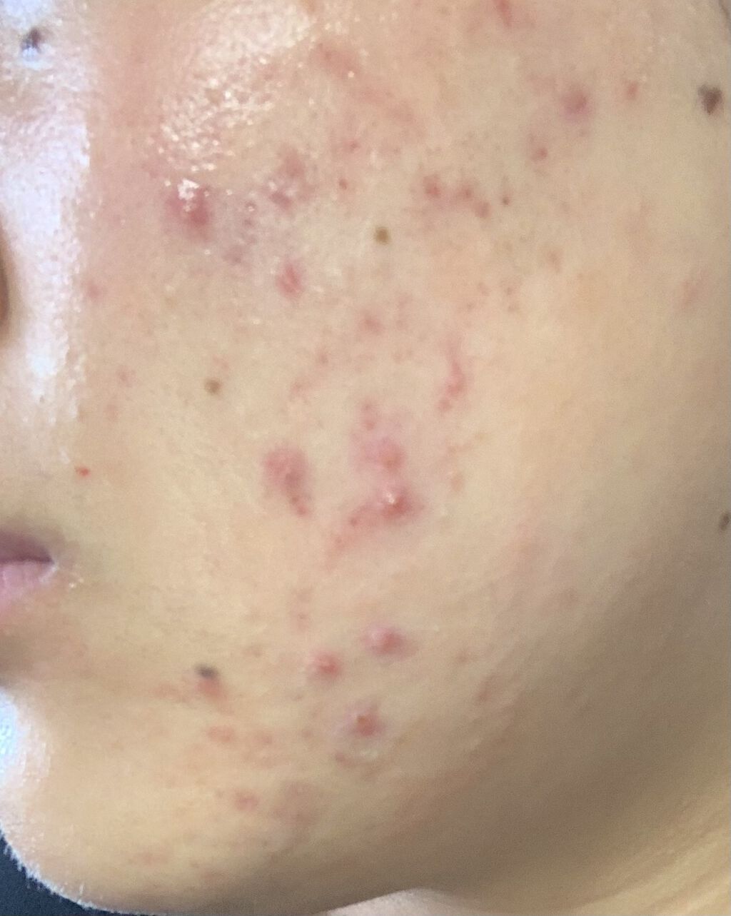 クリンダマイシンゲル(医薬品)/クラシエ薬品/その他を使ったクチコミ（1枚目）