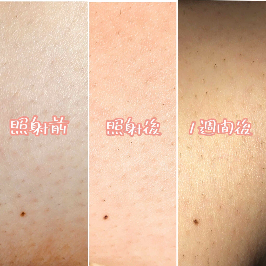 光美容器KE-NON(ケノン)/エムテック/家庭用脱毛器を使ったクチコミ(2枚目)