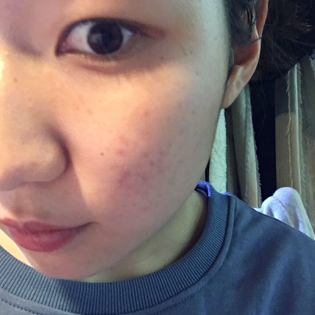 オードムーゲ 薬用ローション(ふきとり化粧水)/オードムーゲ/拭き取り化粧水を使ったクチコミ(2枚目)