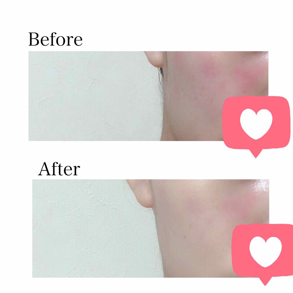 ãð on LIPS ã.ç¡ç äžè¶³ðªãšé£²é
ðºã§èã«èµ€ã¿ð£ãã§ããŠããŸã£ãæã«ãåéãã..ãïŒ2æç®ïŒ