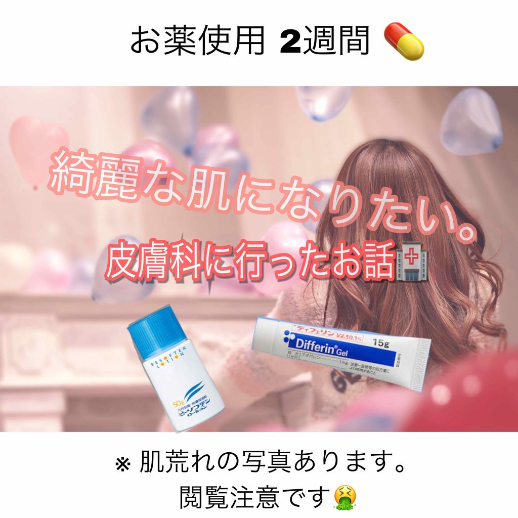 ビーソフテン ローション(医薬品)/持田製薬/その他を使ったクチコミ（1枚目）
