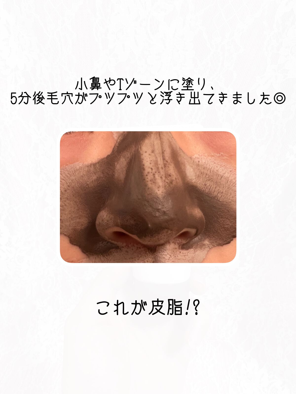 ツルリ 皮脂吸い出し 部分用パック ガスール&レッドパワー/ツルリ/洗い流すパック・マスクを使ったクチコミ(4枚目)