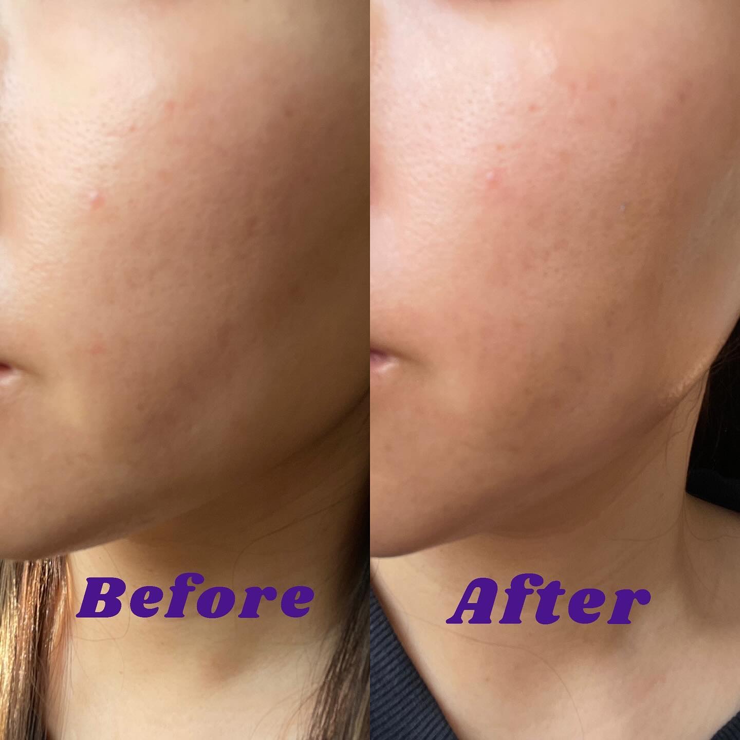 レチノールインテンスリアクティベーションセラム/SOME BY MI/美容液を使ったクチコミ（3枚目）