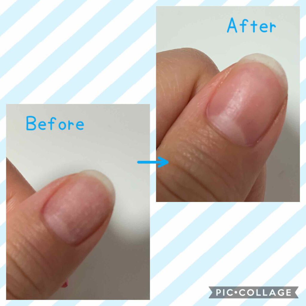 ネイルトリートメント N ネイルネイルの口コミ ネイルネイル ネイルトリートメントlips By Mika M Glitter 混合肌 代後半 Lips