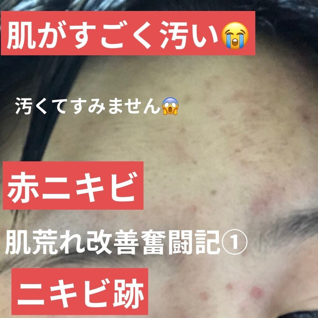 ペアアクネクリームW(医薬品)/ペア/その他を使ったクチコミ(1枚目)