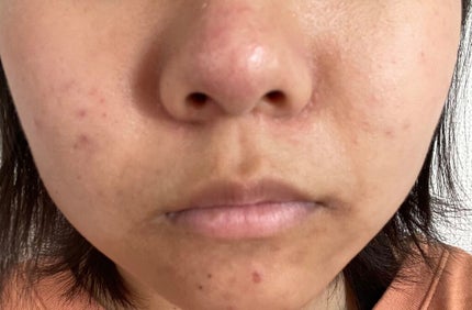 オードムーゲ 薬用ローション(ふきとり化粧水)/オードムーゲ/拭き取り化粧水を使ったクチコミ(3枚目)