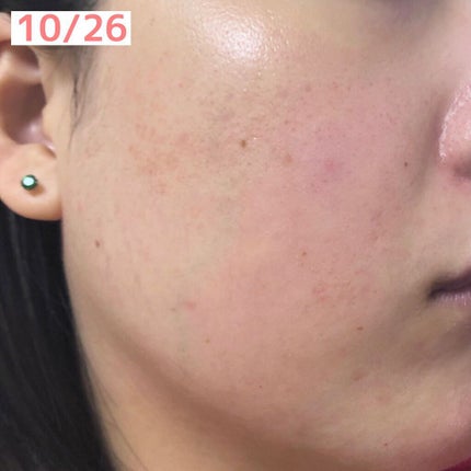 ビタアクナル TX ナイトクリーム/Dr.Different/フェイスクリームを使ったクチコミ(4枚目)