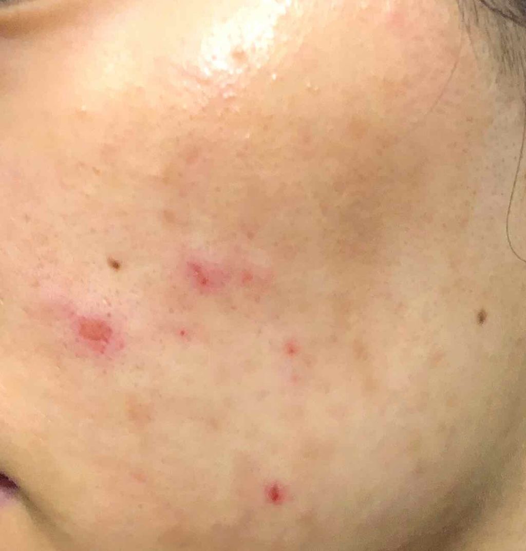 プラチナレーベル VC300オールインワンゲルのクチコミ「2019.9.26

日曜日に、頰にできたかゆいニキビを爪でひっかいてしまいました...
1c.....」（1枚目）