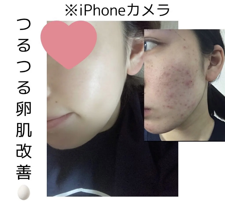 こんなに変わる？！ってくらいほんとにつるつるの肌に大変身した方法🐣






このスキンケアのおかげで
'' ほんと肌綺麗だよね ‼️’’
と言われる事が増えました💓





わたしは小学生から肌荒れには悩まされていました。皮膚科も