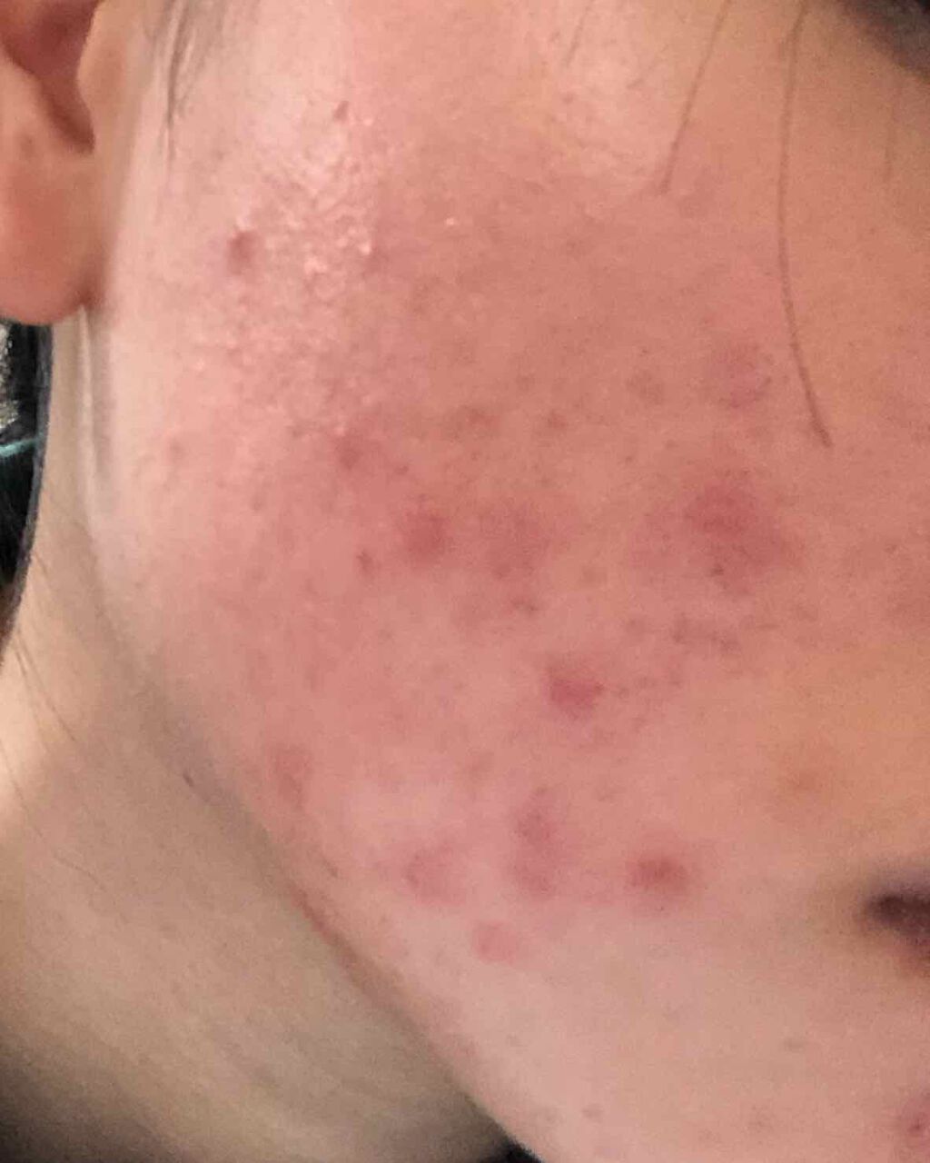 なち on LIPS 「助けて…もうなんで…⚠️汚い肌、ニキビの画像あります。嫌な方は..」(2枚目)