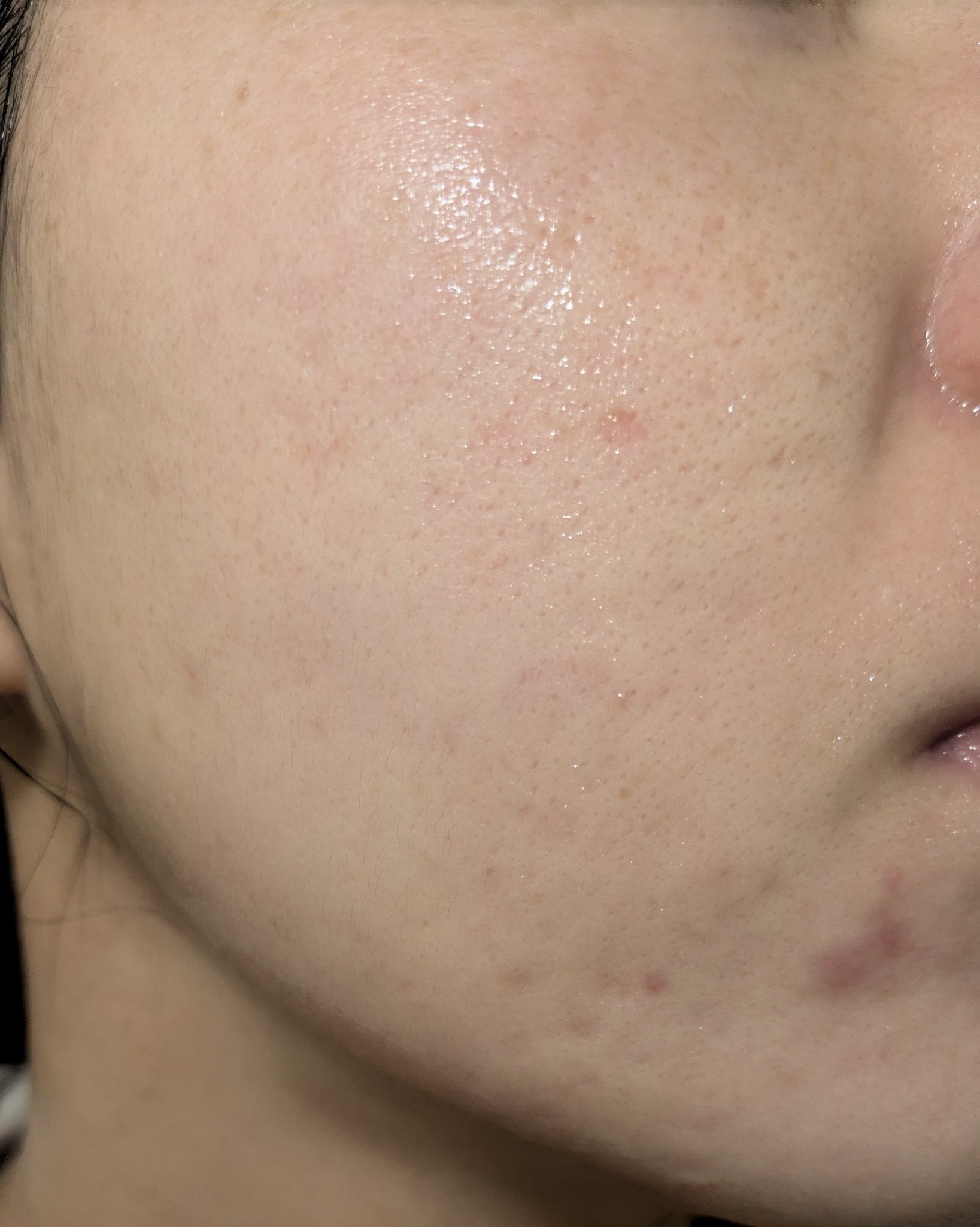 10/24の#汚肌工事録

💐肌がのためにやっていること

💊乳酸菌やビタミンサプリ:朝昼晩(昼はたまに抜かしちゃう)
💊低量ピルも飲んでます！(酷かった生理ニキビや生理痛・PMSは軽減されました)

🥤💧を2L飲むことを意識して