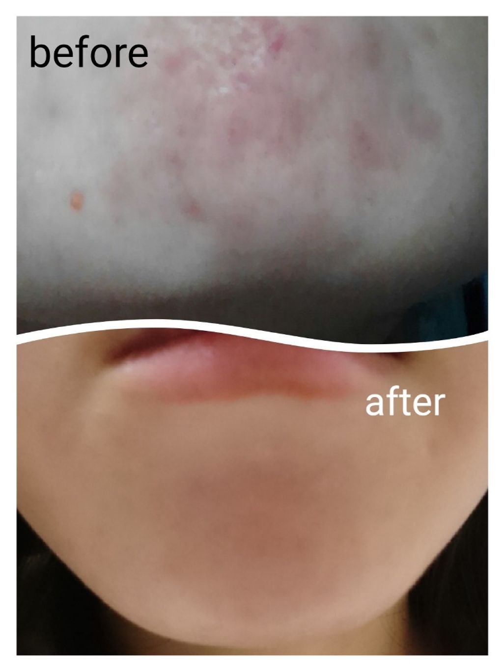 ビーソフテン ローション(医薬品)/持田製薬/その他を使ったクチコミ（2枚目）