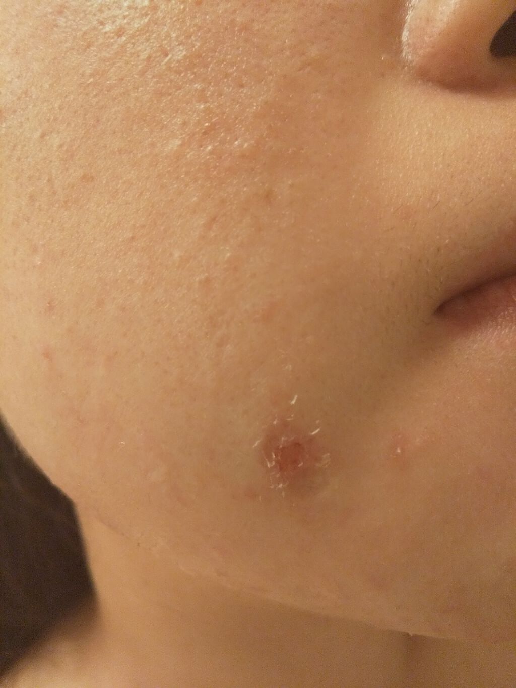 博多美人になりたい on LIPS 「ニキビのケアについて!!!2枚目 汚肌画像あり!!みなさんは顔..」(2枚目)