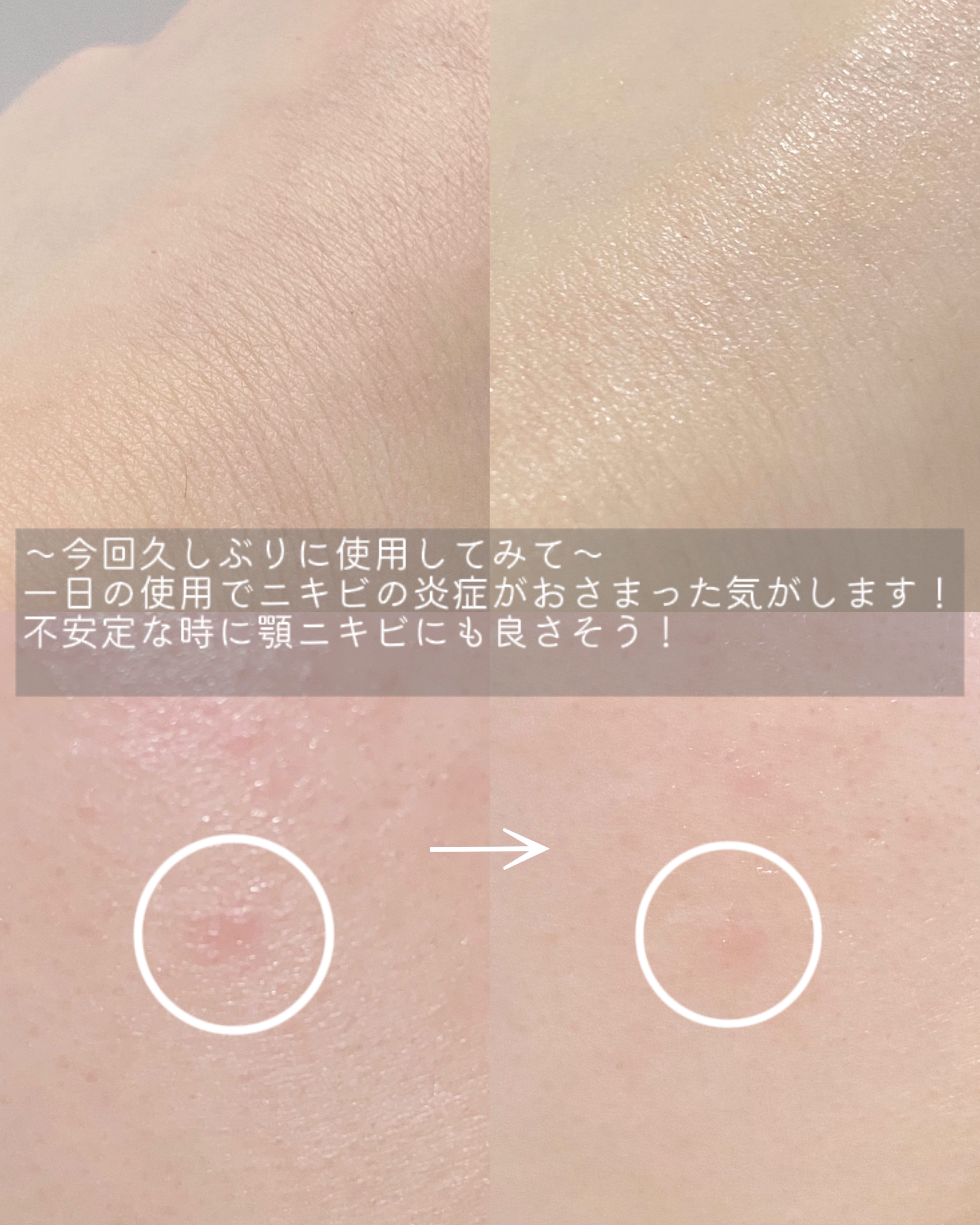 オードムーゲ 薬用ローション（ふきとり化粧水）/オードムーゲ/拭き取り化粧水を使ったクチコミ（3枚目）