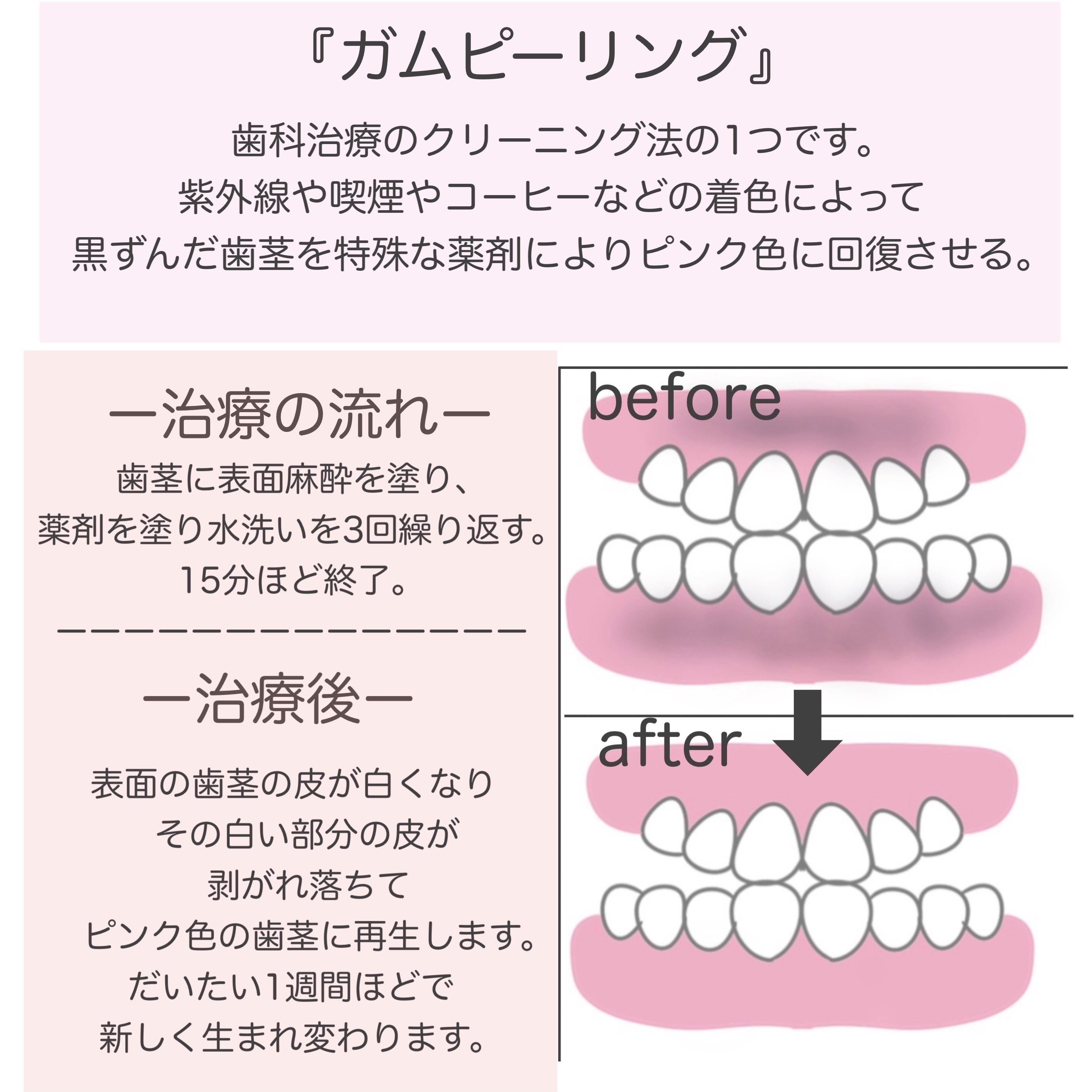 アドバンテージハブラシ コンパクト/クリニカ/歯ブラシを使ったクチコミ（2枚目）