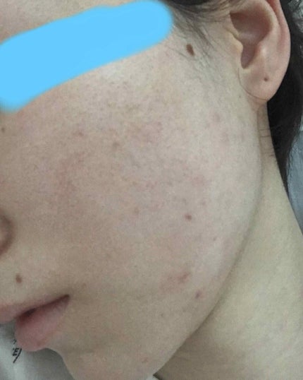 むぎむぎ on LIPS 「肌断食経過記録②10日目最近は日焼け止めとベビーパウダーのみの..」(3枚目)