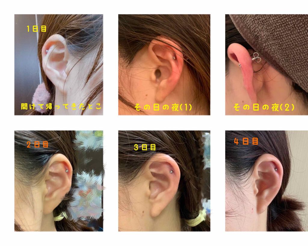 あおこ on LIPS 「ヘリックスを開けてみての経過(3日間)と経験談です!!ピアス開..」(2枚目)
