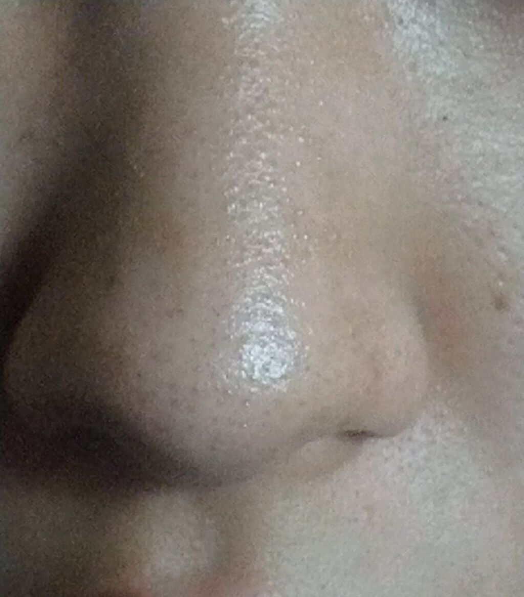 テラ・コートリル 軟膏(医薬品)/ジョンソン・エンド・ジョンソン/その他を使ったクチコミ（2枚目）