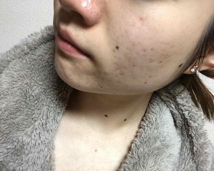 マンスリースキンケアプログラム(旧)/APEX/スキンケアキットを使ったクチコミ(4枚目)