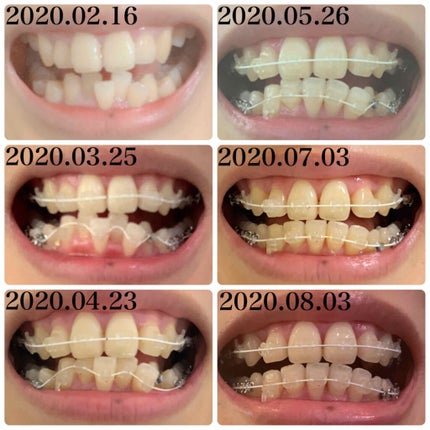ぬぬ on LIPS 「歯列矯正開始して半年ほど経過しました✨歯列矯正したいと思ってい..」(2枚目)