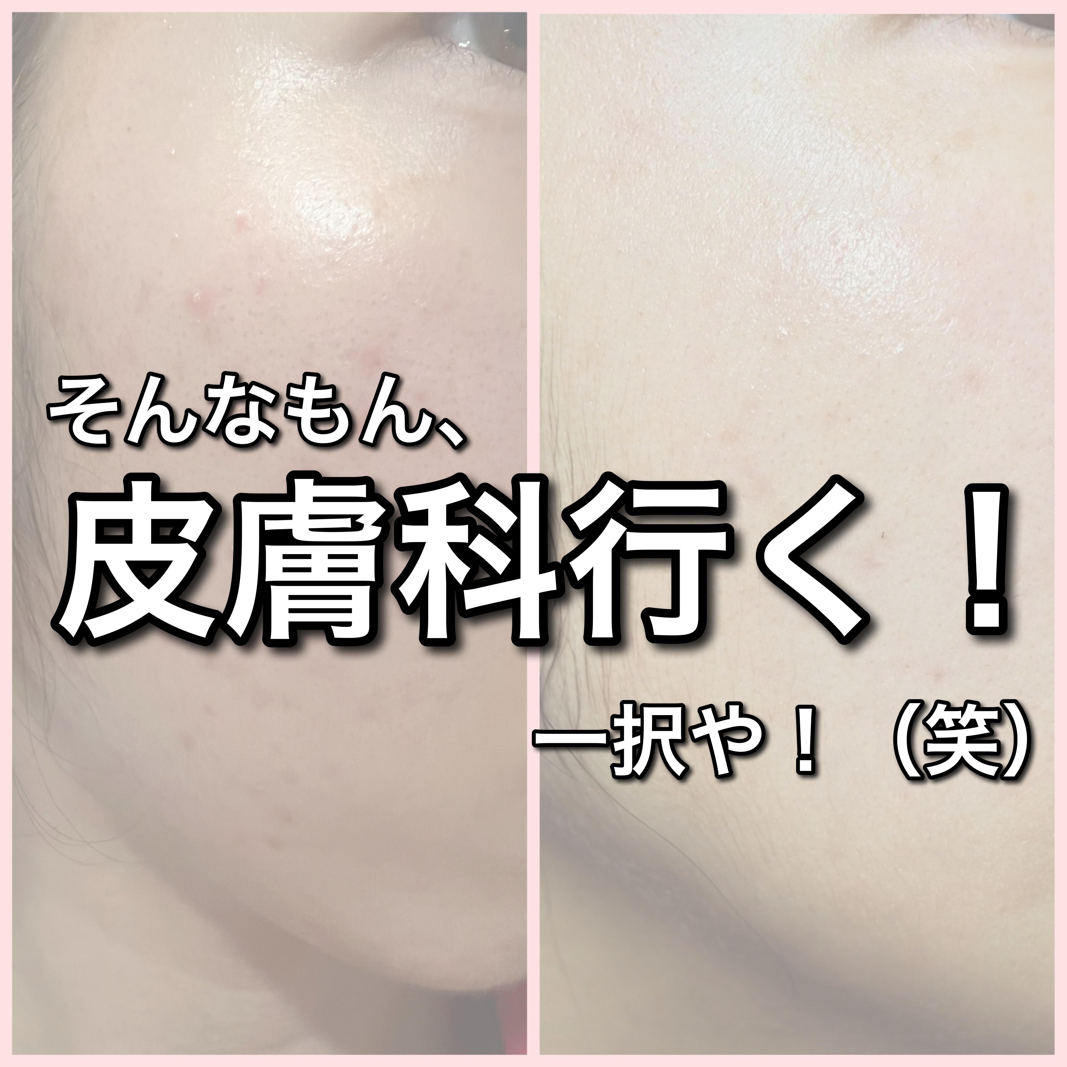 ノブ Ａ アクネソープ/NOV/洗顔石鹸を使ったクチコミ（2枚目）