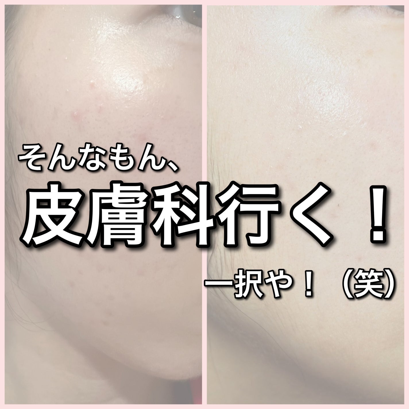 ノブ A アクネソープ/NOV/洗顔石鹸を使ったクチコミ(2枚目)
