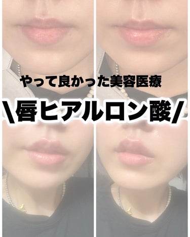 りっちゃん on LIPS 「やって良かった美容医療💉唇ヒアル💋/⚠️唇写真たくさん出ます昔..」（1枚目）