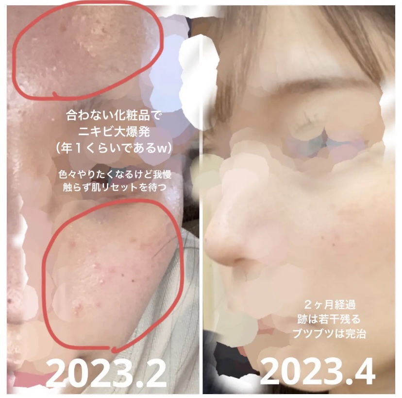 Azelaic Acid Suspension 10%/The Ordinary/美容液を使ったクチコミ（2枚目）