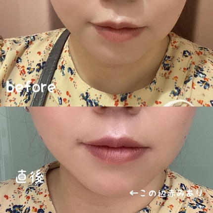 ちっちみ on LIPS 「。*♡……♡*。。*♡……♡*。1週間経ったので、ボトックスの..」(2枚目)