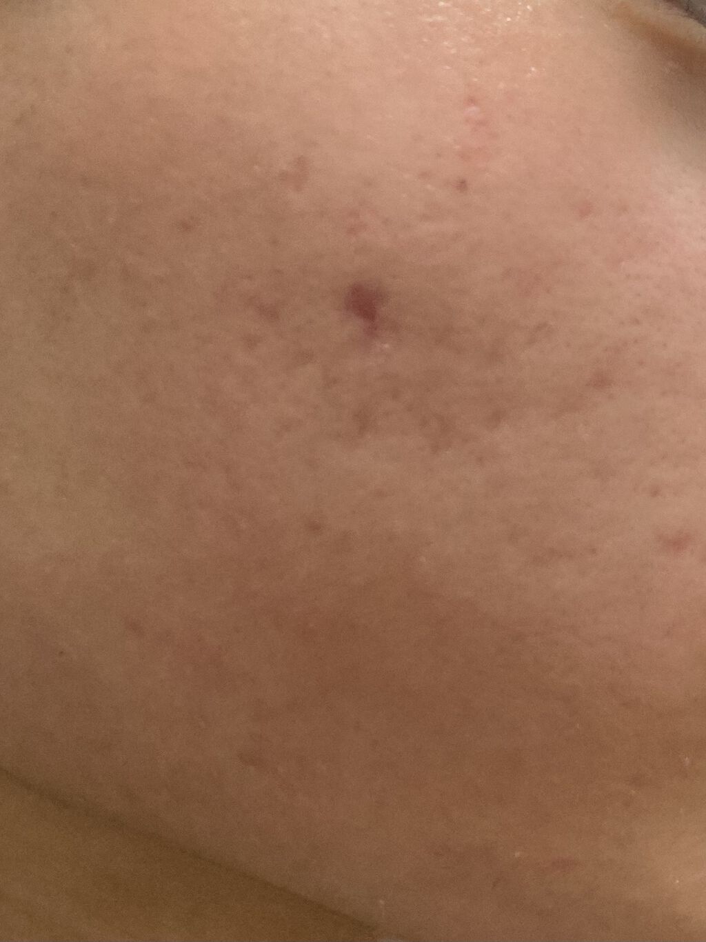 エピデュオゲル/マルホ株式会社/その他を使ったクチコミ（3枚目）