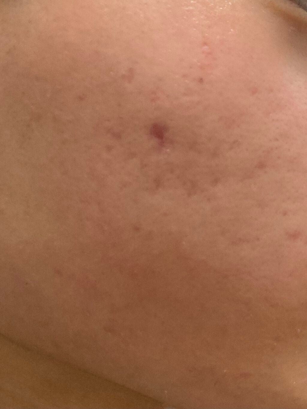 DRX AZAクリア/ロート製薬/その他スキンケアを使ったクチコミ(3枚目)