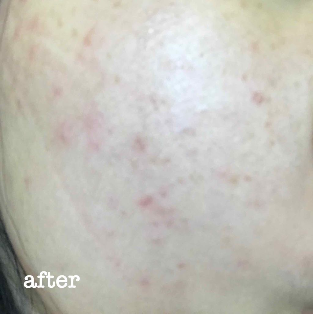 バイオイル/バイオイル/フェイスオイルを使ったクチコミ（3枚目）