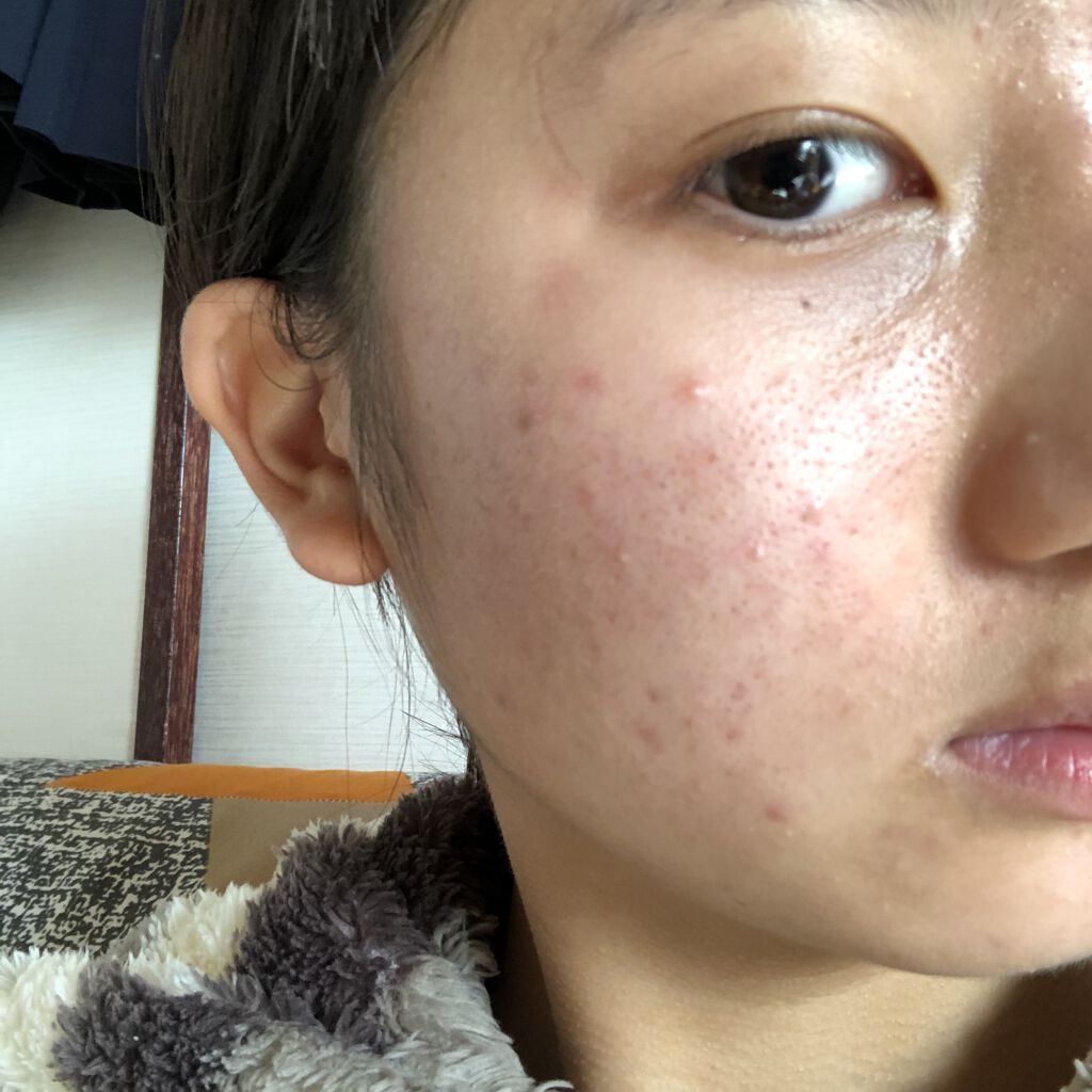 モイスチュア ローション/カルテHD/化粧水を使ったクチコミ（2枚目）