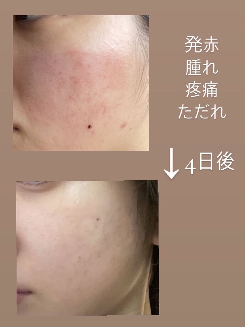 キュアレア（医薬品）/キュアレアa/その他を使ったクチコミ（2枚目）