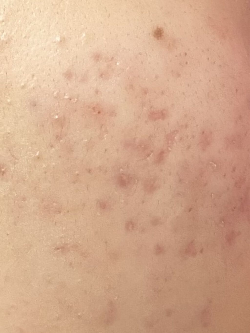 エピデュオゲル/美容皮膚科/フェイスクリームを使ったクチコミ（2枚目）