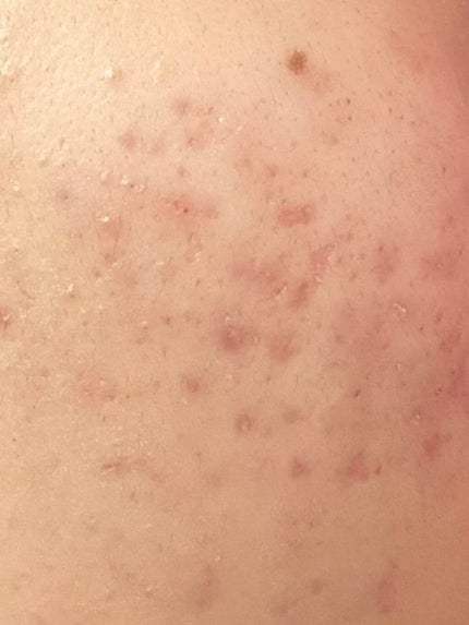 エピデュオゲル/美容皮膚科/フェイスクリームを使ったクチコミ(2枚目)