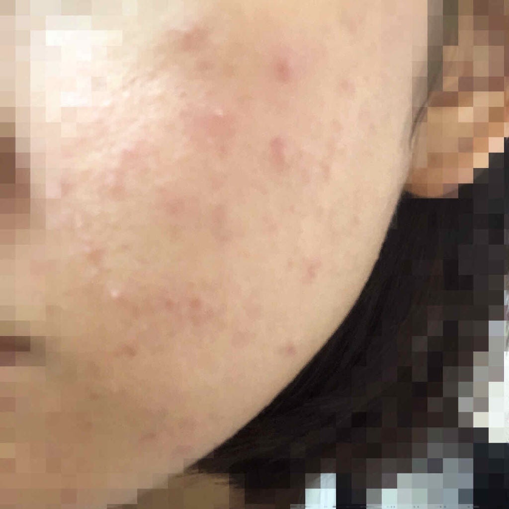 たけだ※たまに投稿 on LIPS 「⚠️肌の写真載せてます⚠️2枚目→皮膚科で出された薬3枚目→化..」(3枚目)