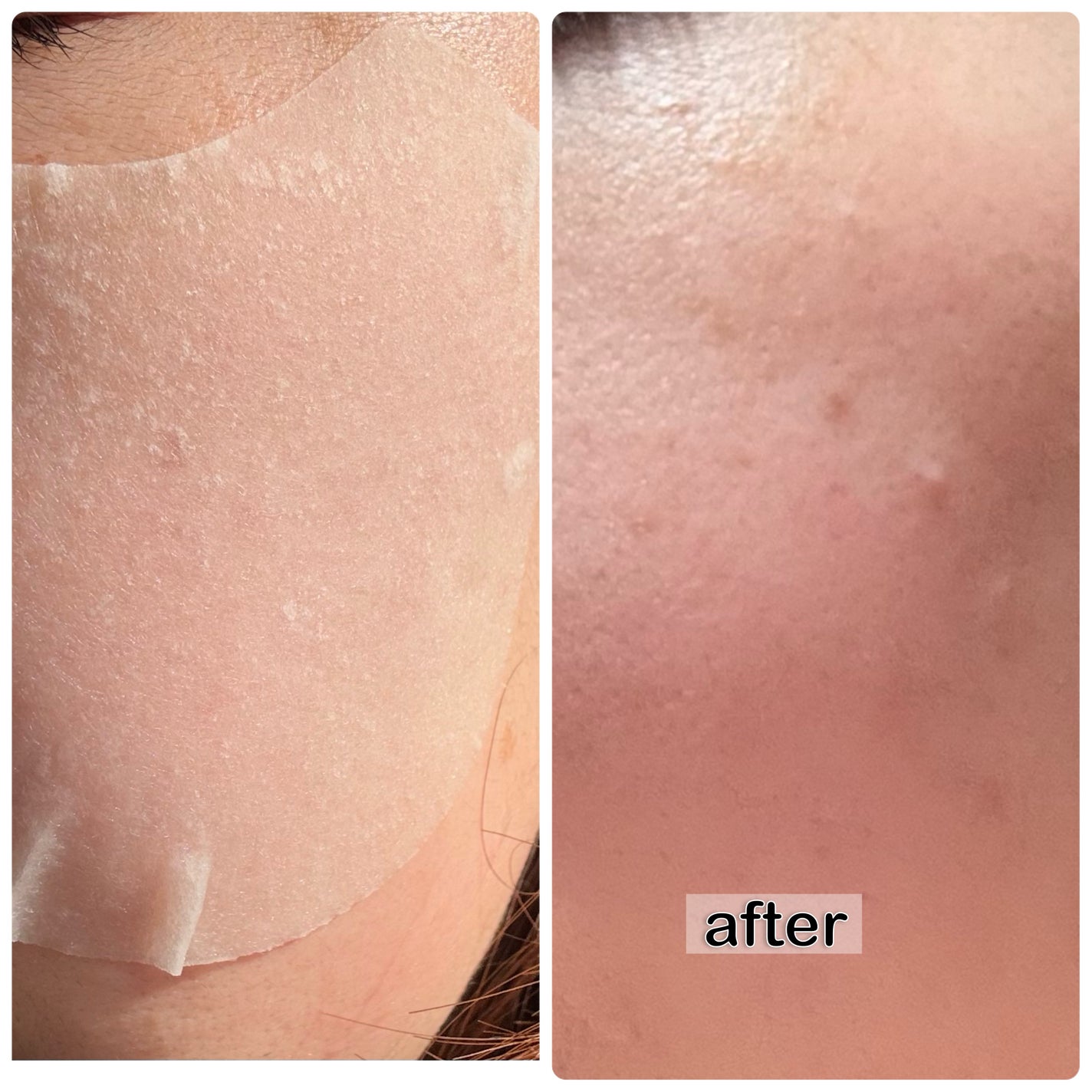 センテラ クイックカーミングパッド/SKIN1004/トナーパッドを使ったクチコミ(6枚目)