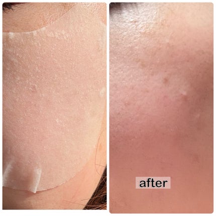 センテラ クイックカーミングパッド/SKIN1004/トナーパッドを使ったクチコミ(6枚目)