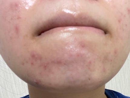 まままこ on LIPS 「ニキビゼロ肌を目指して〜5日目〜⚠️2枚目から肌画像ありスキン..」(4枚目)