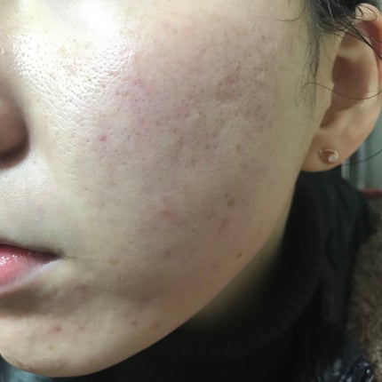 ティーツリーケア ソリューション エッセンシャルマスクEX/MEDIHEAL/シートマスク・パックを使ったクチコミ(2枚目)